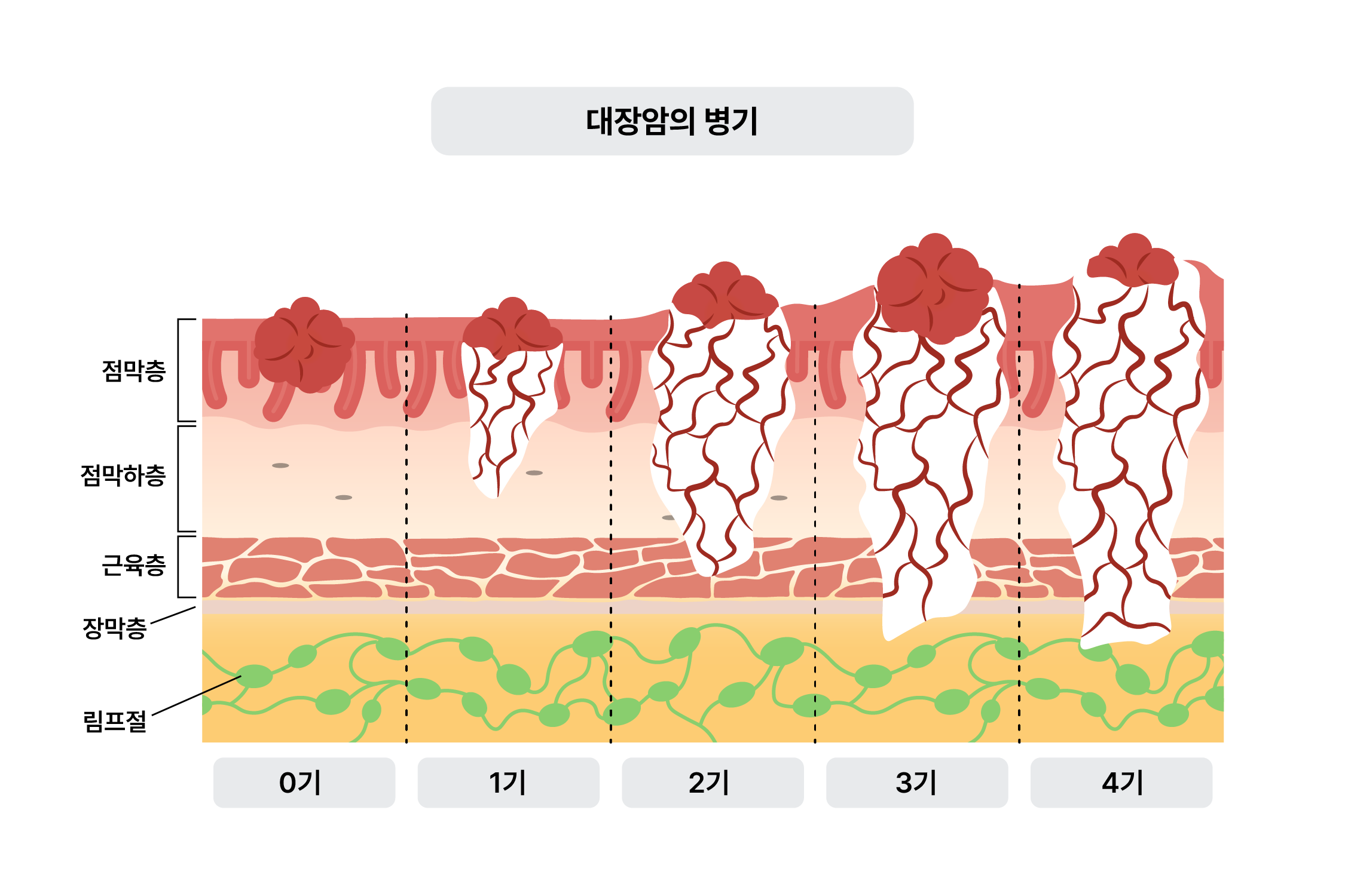진행단계 | 대장암 정보 - 루닛케어